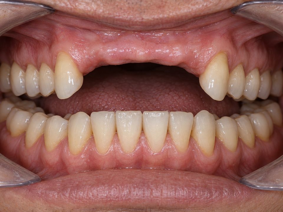Gap from missing upper front teeth