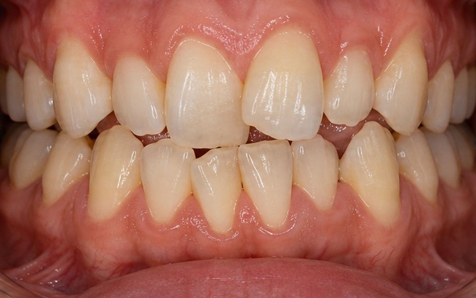 Crowded and overlapping front teeth