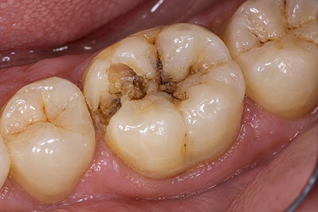 A larger visible cavity affecting a back tooth