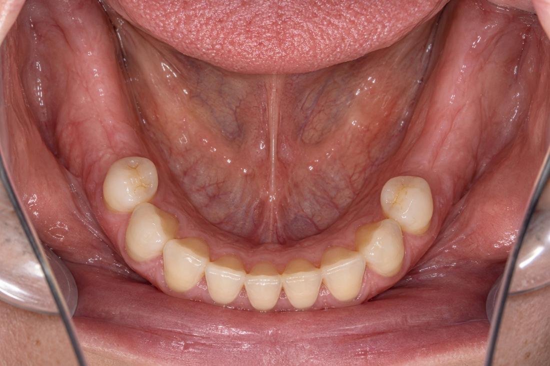 Only a few lower teeth remaining