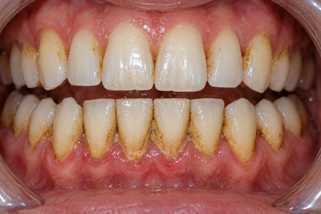 More visible deposits around the lower teeth